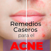 Remedios caseros para el acne